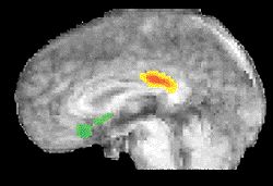 MRI of Happy brain.jpg